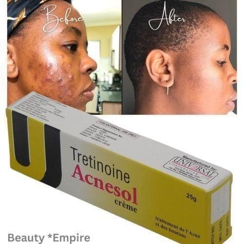 tretinoin Acnesol Acne Cream 25g - Powerful Acne Treatment For Clearer Smoother Skin — Display